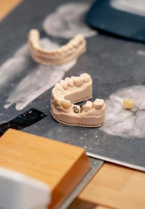 Modelli di impianti dentali - Studio Berton - Treviso