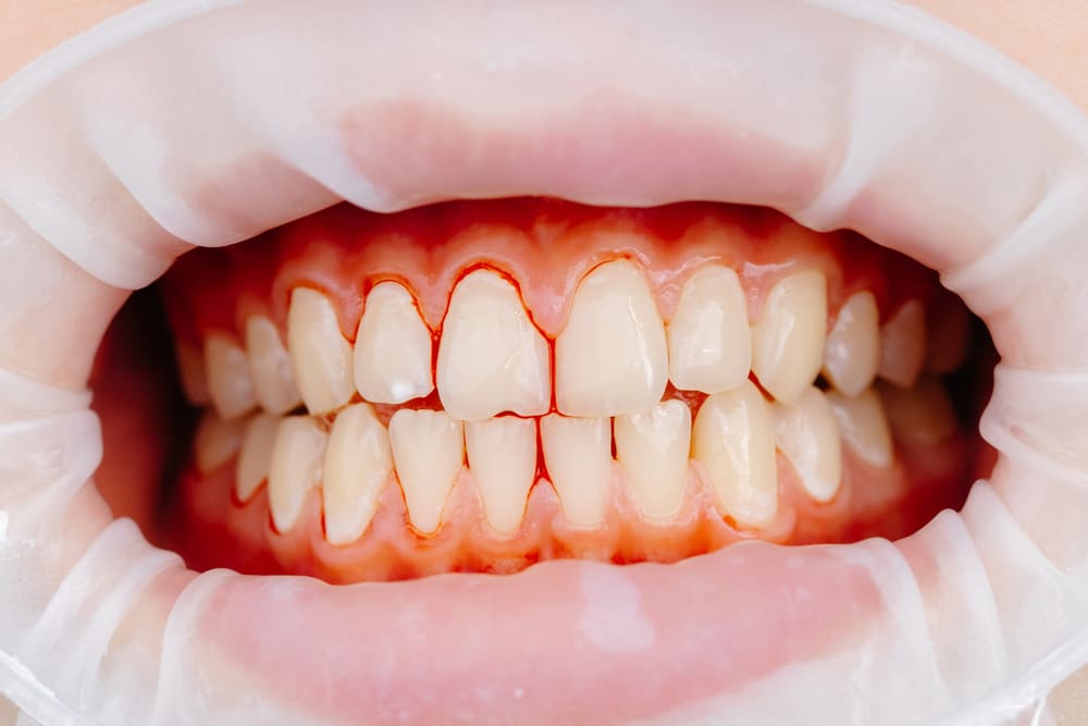 Gengive che sanguinano - Dentista a Treviso