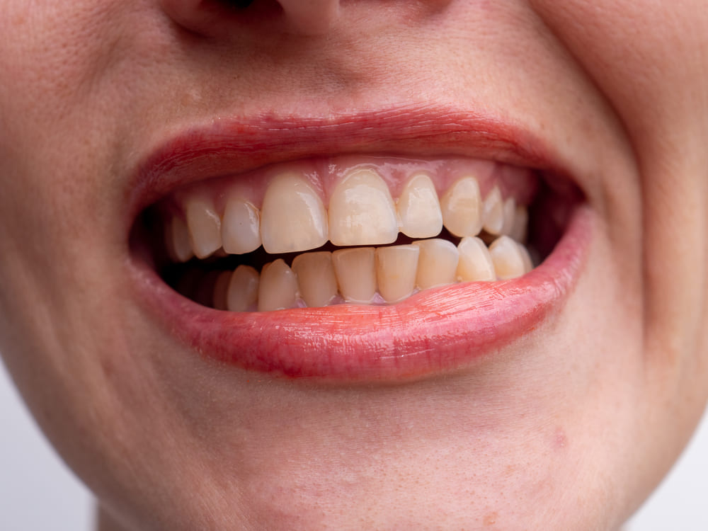 Persona che digrigna i denti - Rimedi al Bruxismo a Treviso